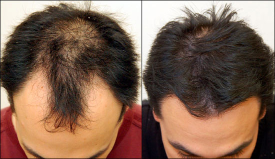 follicle rx résultats