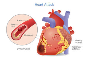 Infarctus du à la prise de stéroïde anabolisant